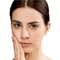 Acne and Marks Treatment