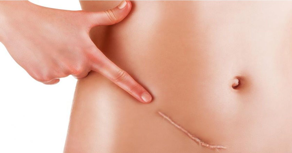 Know More About Surgical Scars in Detail