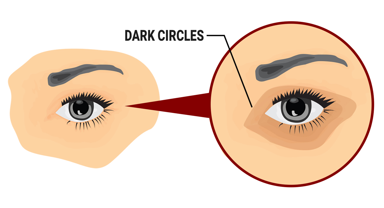 Dark Circles