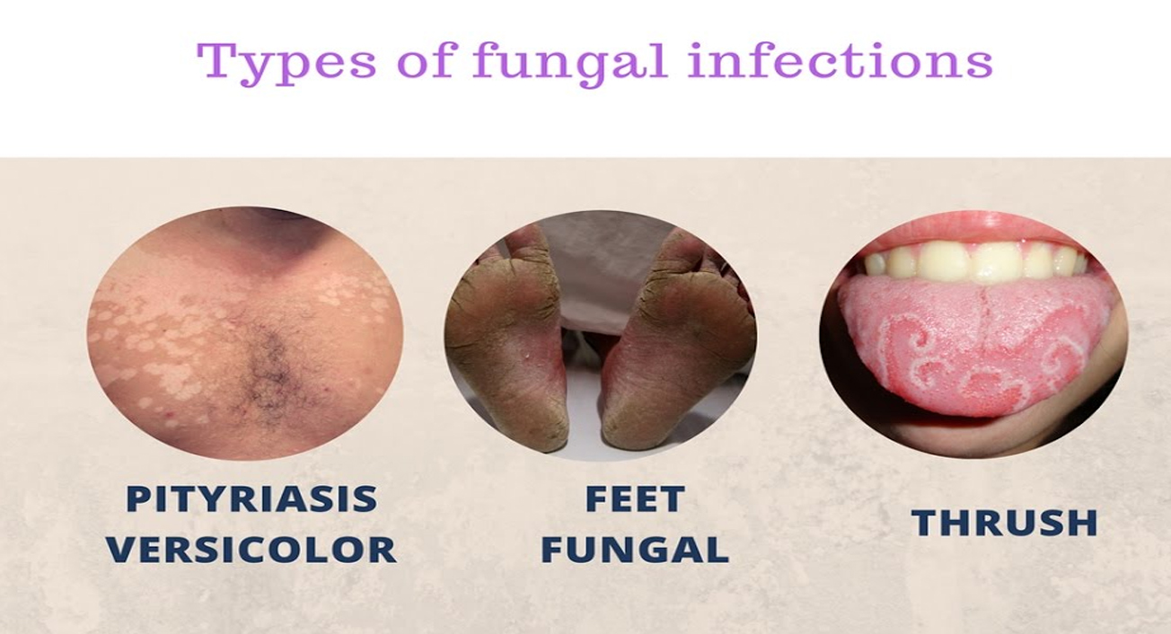 types of fungal infection