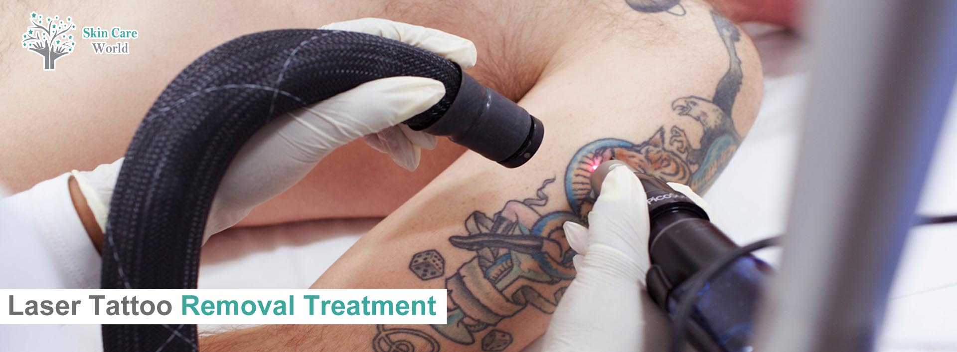 Laser Tattoo Removal Treatment