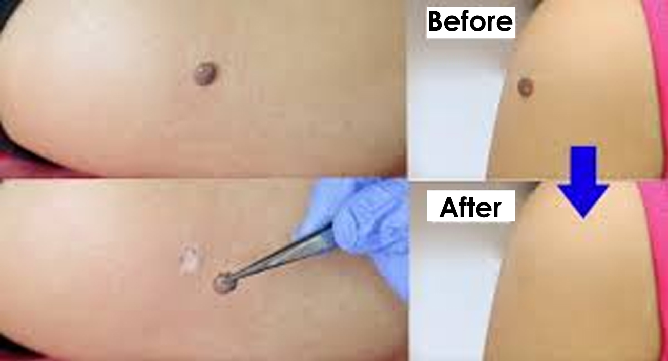 mole before and after removal