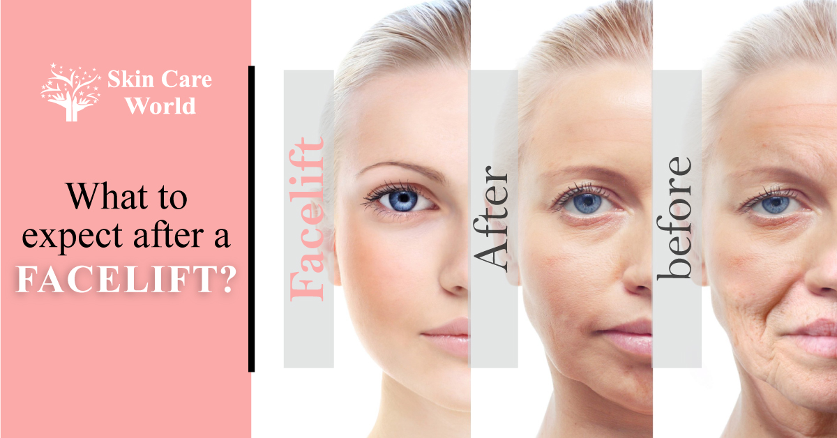 What to Expect After a Facelift?