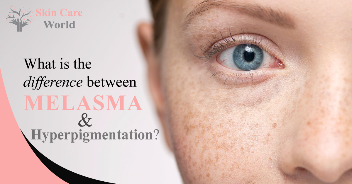 The Difference Between Melasma and Other Skin Spots