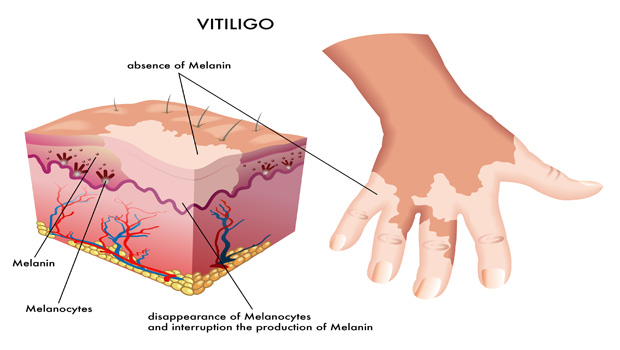 vitiligo causes and treatment