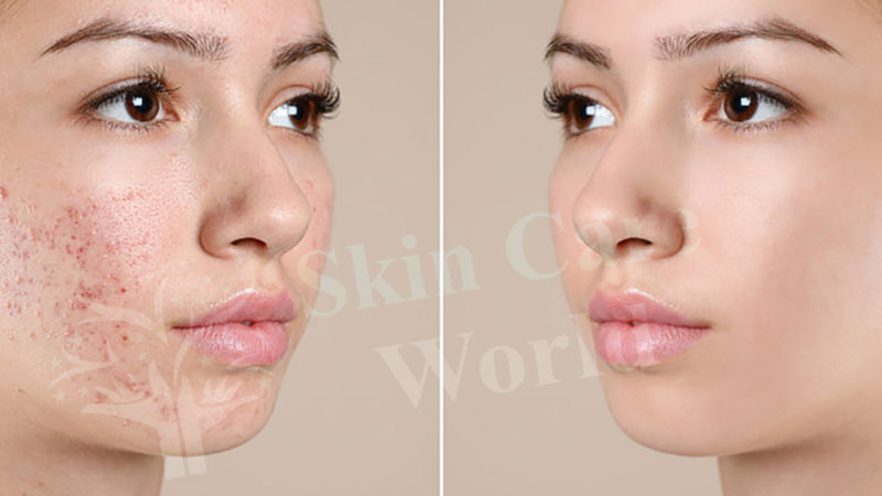 acne surgery in Gurgaon