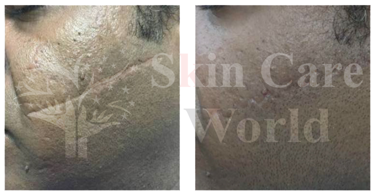 Scar Revision Surgery in Gurgaon