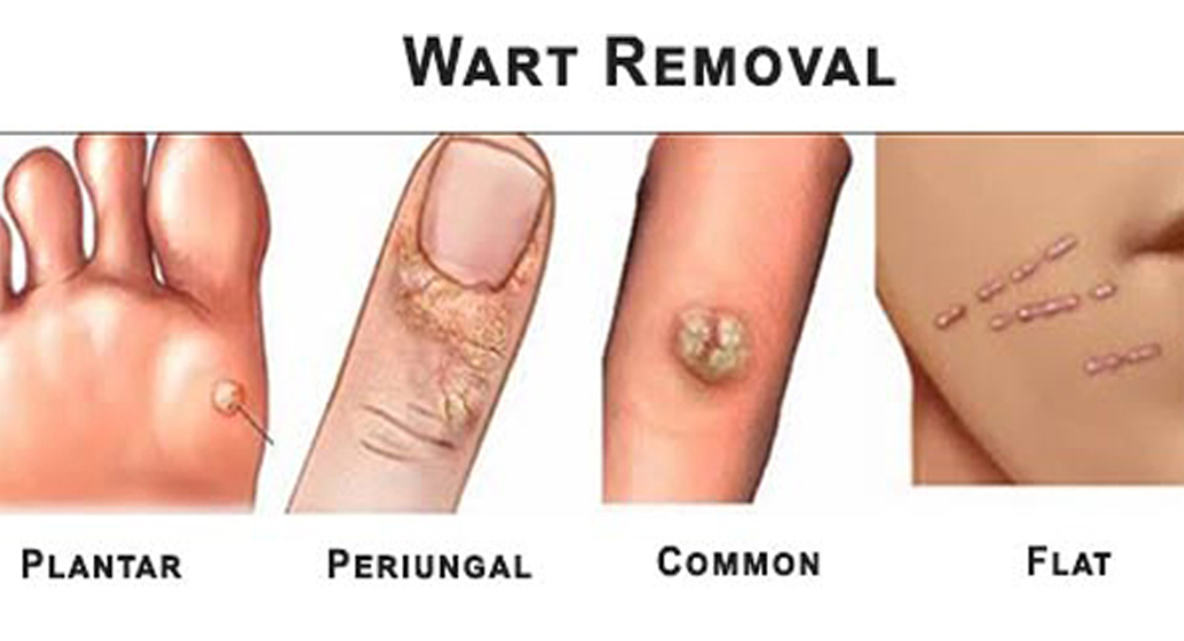 Treatment for Removing Warts